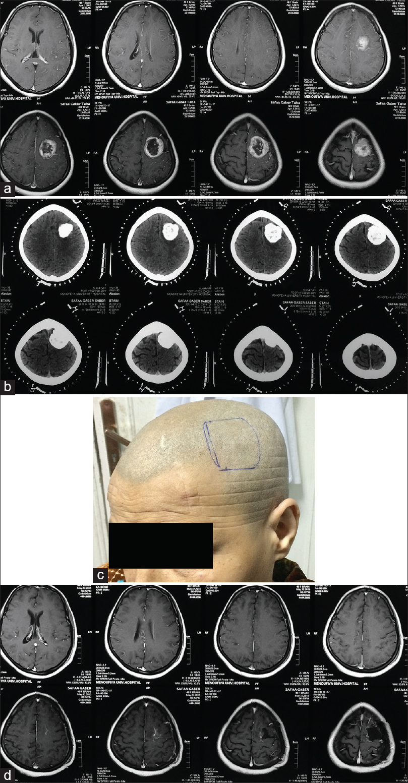 (a) Magnetic resonance T1-weighted images show left high parietal tumor, (b) computed tomography scans with superimposed craniomapper show the left high parietal tumor, (c) patient's photo shows scalp marks denoting the exact place of the tumor, and (d) postoperative magnetic resonance T1-weighted images with contrast show complete removal of the tumor