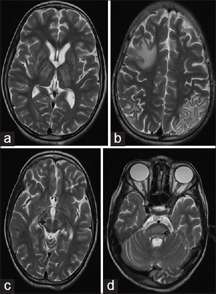 T2-weighted magnetic resonance imaging brain shows bilateral symmetrical basal ganglia and thalamic hyperintensities (a) along with asymmetrical subcortical white matter hyperintensities. (b) Midbrain signal changes show the classical “Face of giant panda” sign with tegmentum involvement appearing hyperintense (arrow) while the relatively preserved red nucleus and lateral portion of substantia nigra pars reticulata, appearing hypointense. (c) Central pontine myelinolysis-like changes in the pons resulted in a “Bisected Pons” appearance with relatively preserved pontine tissue showing up as a dark horizontal line (arrow) (d)