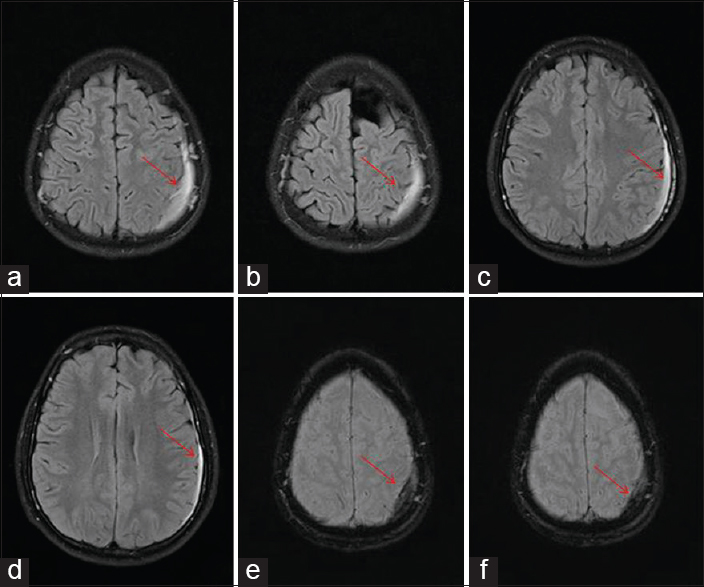 Brain magnetic resonance imaging fluid-attenuated inversion recovery imaging axial view (a-d) shows left frontoparietal subdural hematoma with no mass effect or midline shift (red arrow); (e and f) gradient echo shows bleed