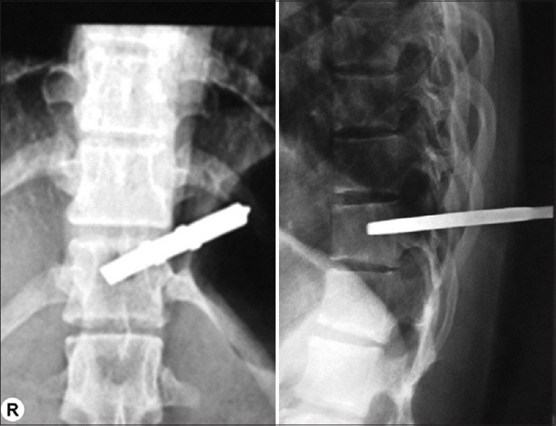 Radiograph showing metallic foreign body at D12 level reaching almost up to the mid of vertebral body