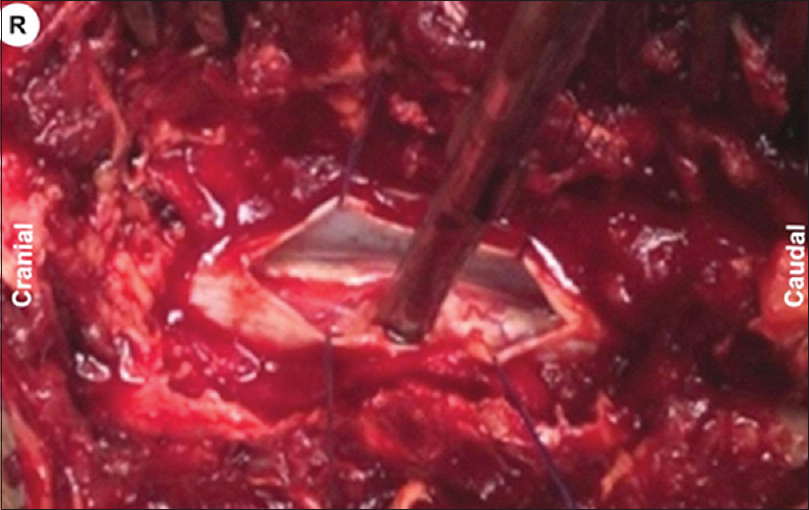 Intraoperative image showing metallic object (screwdriver) penetrated through the spinal cord