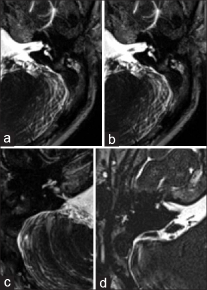 Axial high-resolution thin T2 images of magnetic resonance imaging of left (a and b) and right inner ear (c and d) revealed normal signal intensity of cochlear turns (a) with the loss of normal hyperintense signal involving the vestibule and semicircular canals on the right side. (b) On left side, there was loss of normal cochlear signal (c) with only partial visualization of parts of lateral and superior semicircular canals (d)