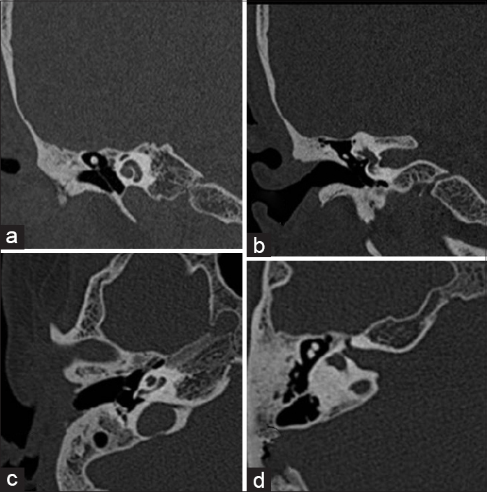 Axial (a and b) and coronal (c and d) high-resolution computed tomography sections of right temporal bone showing the presence of normal cochlea (a and c), no calcification or ossification of superior and lateral semicircular canals (b) with ossification in posterior semicircular canal (d)