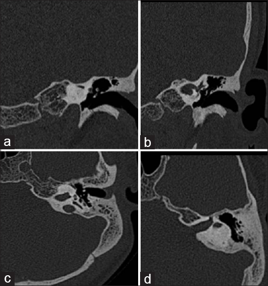 Axial (a and b) and coronal (c and d) high-resolution computed tomography sections of left temporal bone showing complete ossification of the cochlea (a) with ossification of posterior semicircular canal (c) Left lateral and superior semicircular canals show no evidence of (b and d)