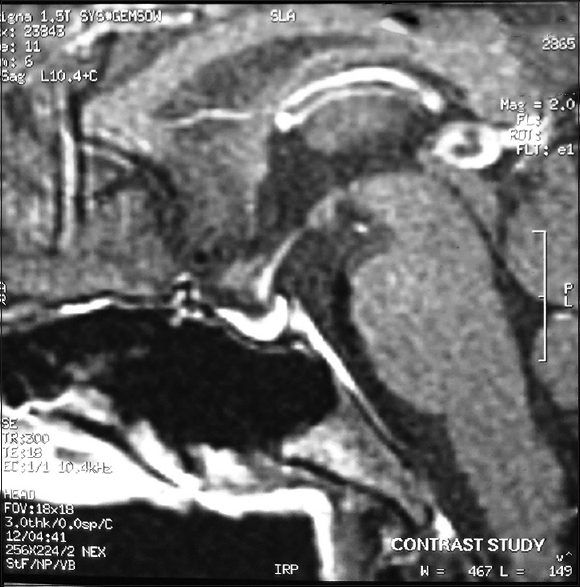 Magnetic resonance imaging showing partially empty sella