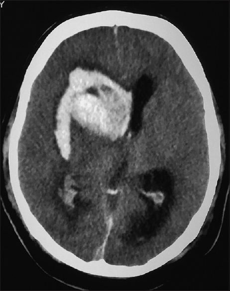 Computed tomography of the brain of patient B