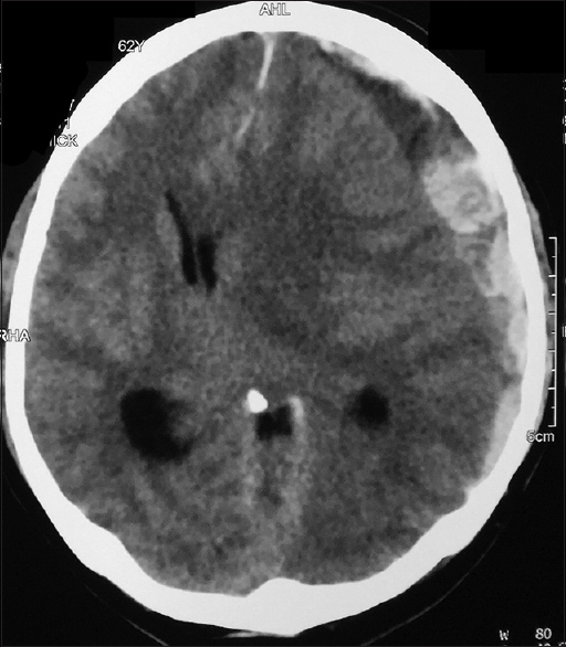 Computed tomography of the brain of patient G