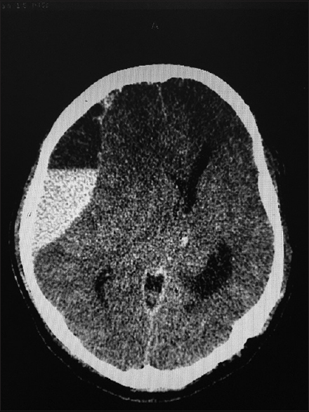 Computed tomography of the brain of patient A