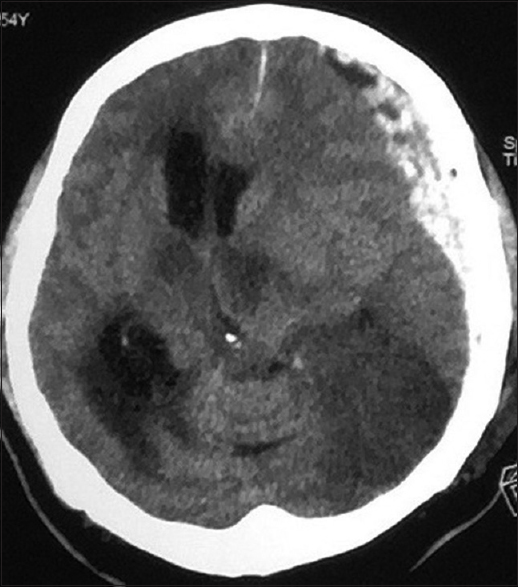 Computed tomography of the brain of patient C