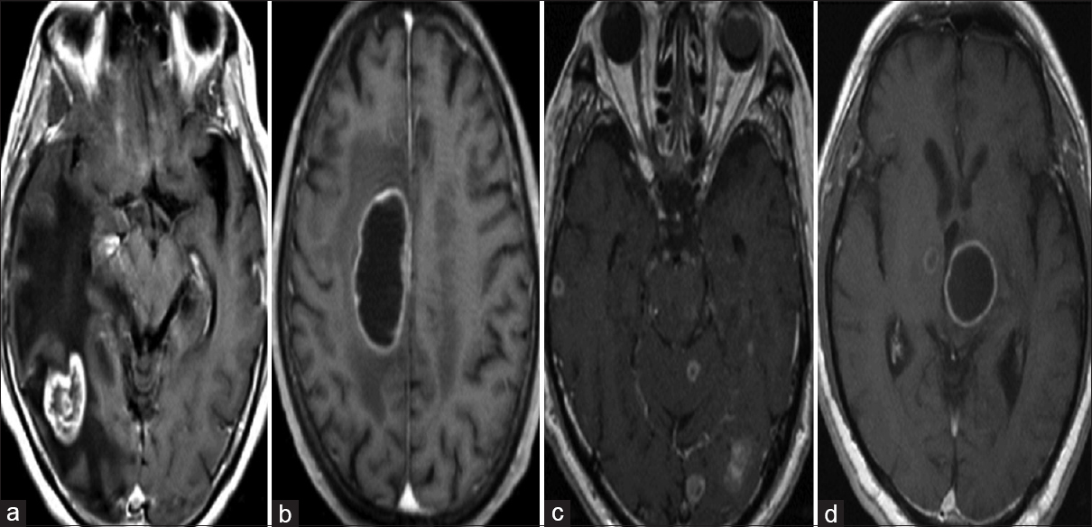 Radiologic patterns. (a) Single/nodular type. (b) Single/cystic type. (c) Multiple/nodular type. (d) Multiple/cystic type