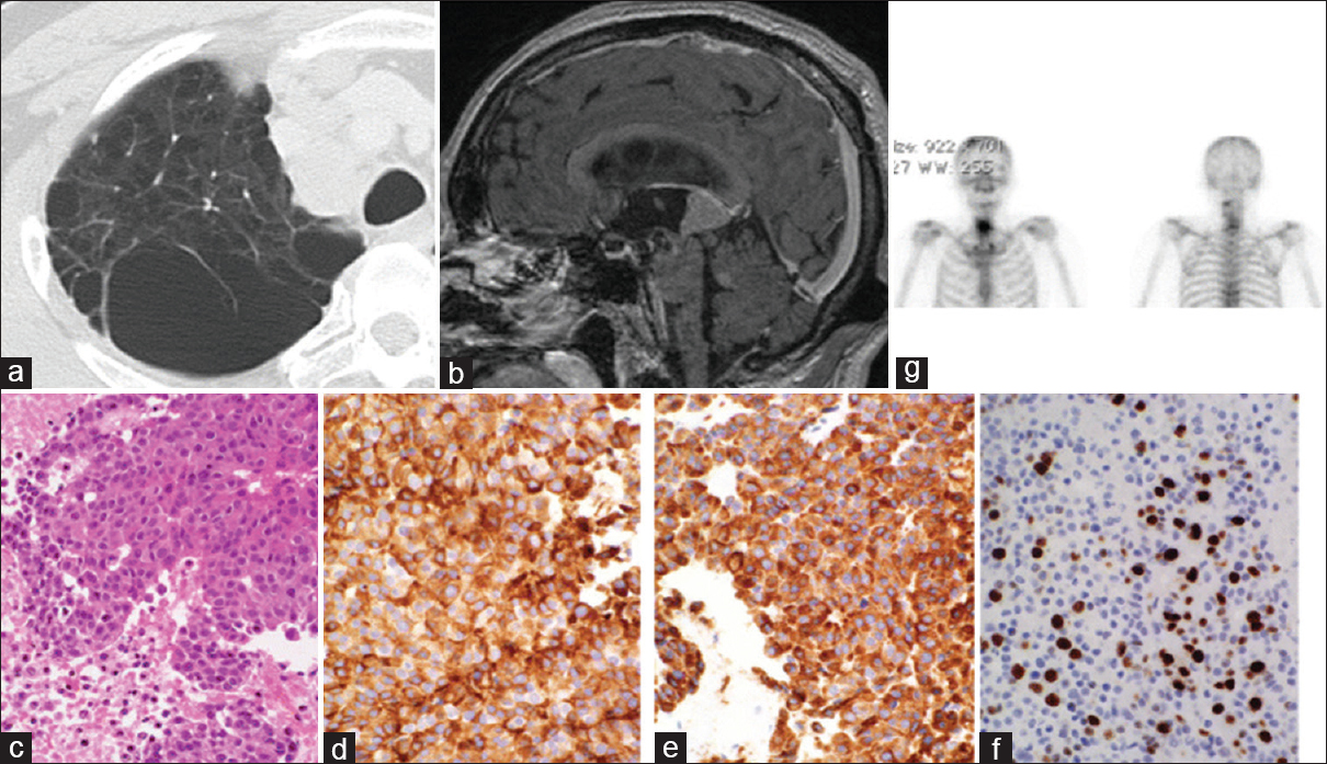 (a) Chest computed tomography scan shows a small lesion on the mediastinum at right S2. (b) Sagittal contrast-enhanced T1-weighted head magnetic resonance imaging reveals two tumors in the pineal body and the cerebellum accompanied by obstructive hydrocephalus. (c) H and E, stain image of neuroendoscopic biopsy tissues (—200). (d) anti-synaptophysin antibody stain image (—200). (e) Anti-chromogranin A antibody stain image (—200). (f) MIB-1 stain image (×200). (g) Bone scintigraphy shows multiple metastases to the cervical vertebrae