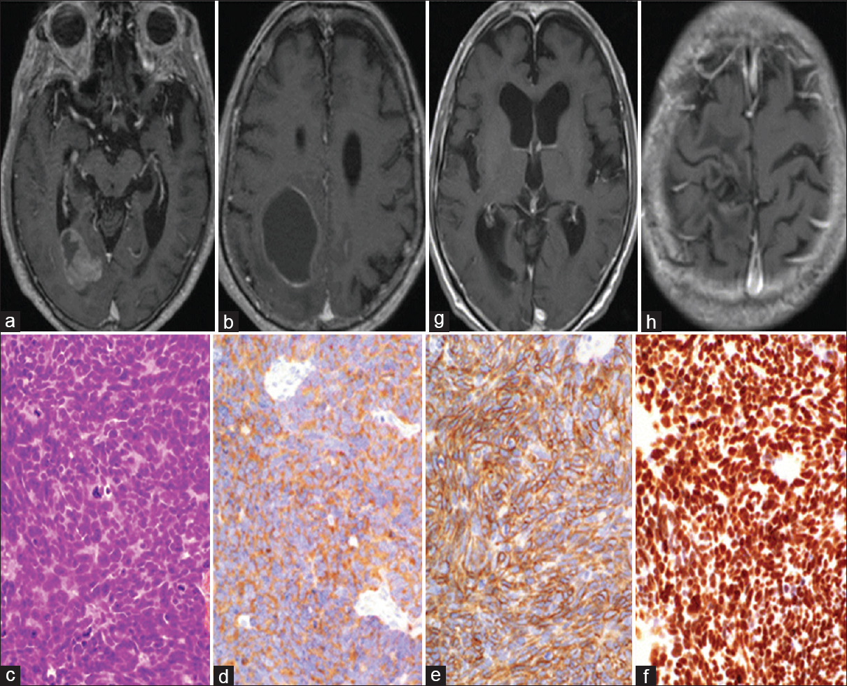 (a and b) Horizontal contrast-enhanced T1-weighted head magnetic resonance imaging shows multiple tumors with cysts in the right occipital lobe and the parietal lobe. (c) H and E, image of the isolated parietal lobe tumor tissues (—200). (d) Anti-synaptophysin antibody stain image (—200). (e) Anti-CD56 antibody stain image (—200). (f) Anti-TTF-1 antibody stain image (—200). (g and h) Horizontal contrast-enhanced T1-weighted head magnetic resonance imaging after cranial irradiation therapy