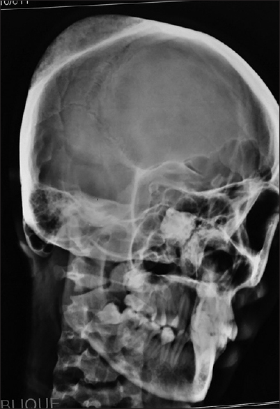 Lateral views of plain X-ray skull revealing classical honeycomb appearance lesion