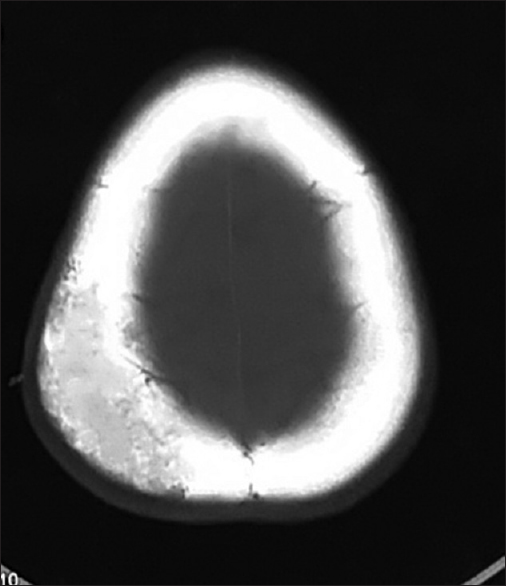 Noncontrast computed tomography head (axial view, bone window) image showing the hypodense lesions with sharp, thickened, and sclerotic margins