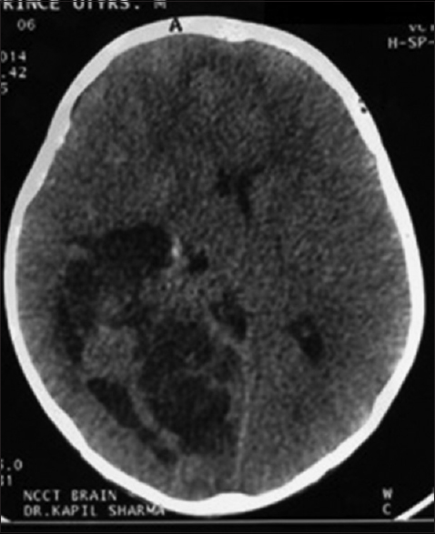 Axial computed tomography scan of the brain