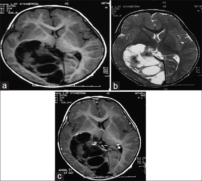 (a) Axial T1-weighted magnetic resonance imaging brain, (b) axial T2-weighted magnetic resonance imaging brain, (c) contrast axial magnetic resonance imaging brain. (a-c) T1-weighted, T2-weighted and post contrast T1-weighted magnetic resonance imaging images shows cystic components appearing hypointense on T1-weighted and intensely hyperintense on T2-weighted scans. Few septations were also seen in cystic area. Solid components are iso intense on T1-weighted and iso to intermediate intense on T2-weighted scans