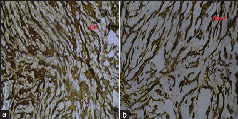 Glial fibrillary acid protein 2, (a and b) glial fibrillary acidic protein, vimentin, and S100 were positive in the tumor cells. NF was focal positive in the tumor cells. P53, synaptophysin, and CD34 were negative. KI 67/MB was approximately 0% (b) S100