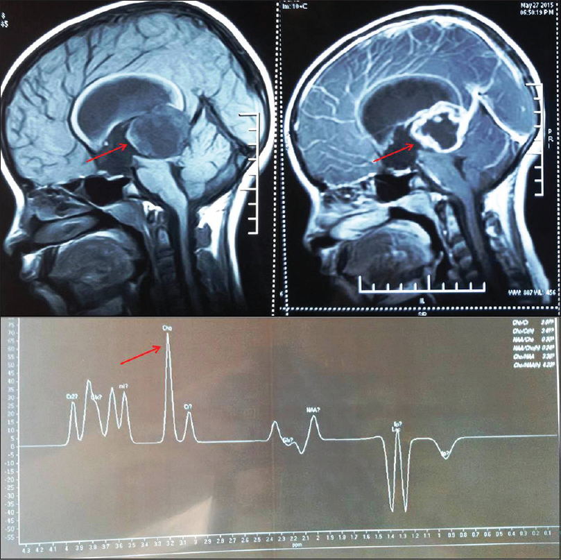 Contrast-enhanced magnetic resonance imaging with magnetic resonance spectroscopy revealed a mass in the pineal region showing iso- to hypo-intense signals on T1-weighted (arrow) and hyperintense signals on T2-weighted images with marked peripheral enhancement (arrow) on postcontrast scan. The spectroscopy from the peripheral part of the lesion shows elevated choline peak (arrow)