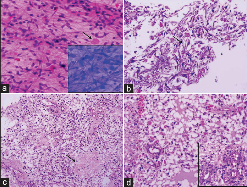 Photomicrographs showing histomorphologic features of Case 1. (a) Frozen section showing a glial tumor comprising bipolar piloid cells admixed with numerous eosinophilic granular bodies (arrow), inset showing toluidine blue image (H and E, ×200), (b) paraffin section of the frozen tissue showing piloid cells in a fibrillary background with abundant Rosenthal fibers (arrow) and eosinophilic granular bodies (H and E, ×200), (c and d) main tissue sections displaying hypocellular (arrow) and hypercellular areas with glomeruloid vessels in the inset (H and E, ×200)