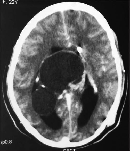 Contrast-enhanced computer tomography scan showing a large well-defined cystic mass with peripheral coarse calcification in the pineal region extending through the 3rd ventricle to involve both lateral ventricles and compressing medial part of the bilateral cerebellar hemispheres with the effacement of the 4th ventricle