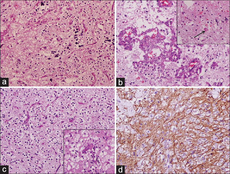 Photomicrographs showing histomorphology and immunohistochemistry features of Case 2. (a) The hypocellular area of the tumor showing piloid cells in a prominent fibrillary background with areas of calcification (H and E, ×200), (b) tumor showing glomeruloid vascular proliferation and occasional eosinophilic granular body in the inset (arrow), (c) the cellular area delineated an oligodendroglial-like morphology and focal area of foam cell change in the inset (H and E, ×200), (d) glial fibrillary acidic protein stain showing diffuse fibrillary positivity (×200)