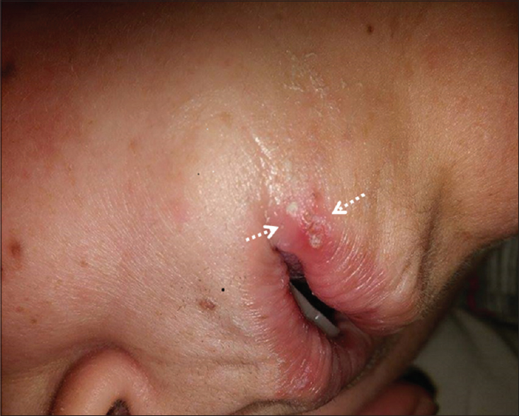 Erythematous vesicular lesions in left oral mucosa (arrows)