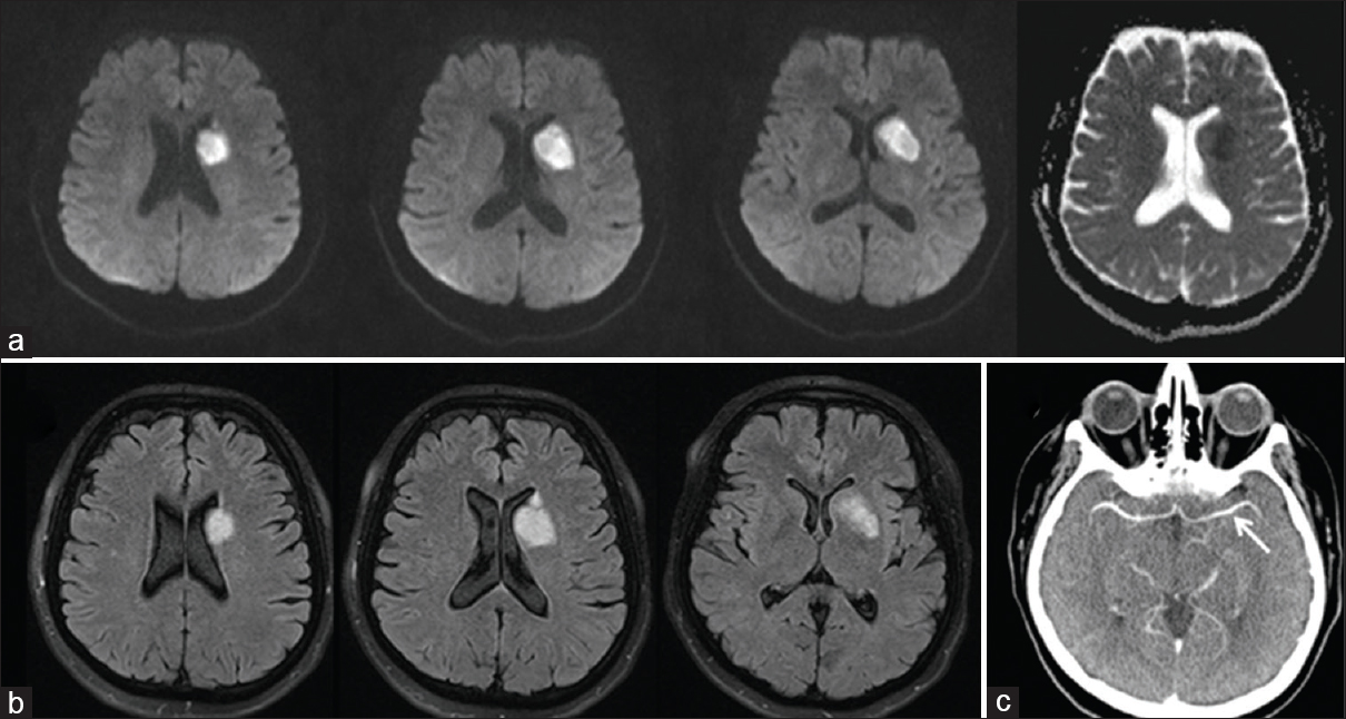 (a) Diffusion-weighted imaging and apparent diffusion coefficient sequences showing restricted diffusion in the corona radiata and basal ganglia corresponding to the territories of the left lenticulostriate arteries. (b) Fluid attenuation inversion recovery sequences showing hyperintensity in the same regions. (c) Brain tomography angiography showing intact left M1 segment