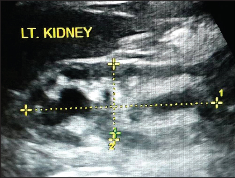 Left kidney shows moderate hydronephrosis with scarring at lower pole, consistent with reflux nephropathy