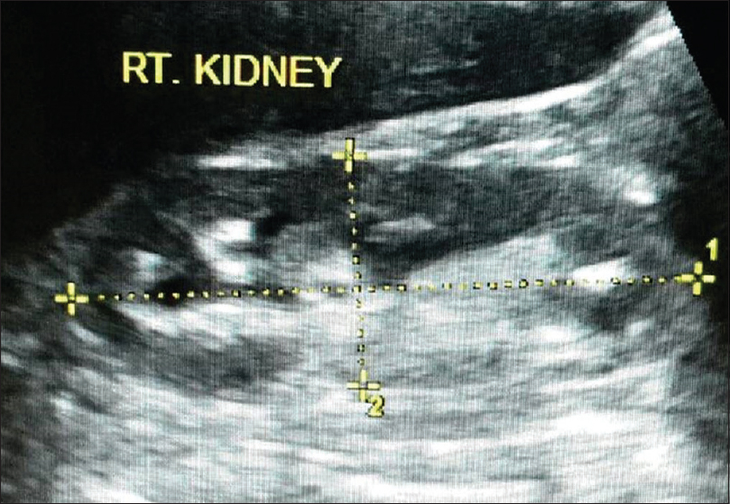 Right kidney shows mild hydronephrosis. No evidence of any scarring noted