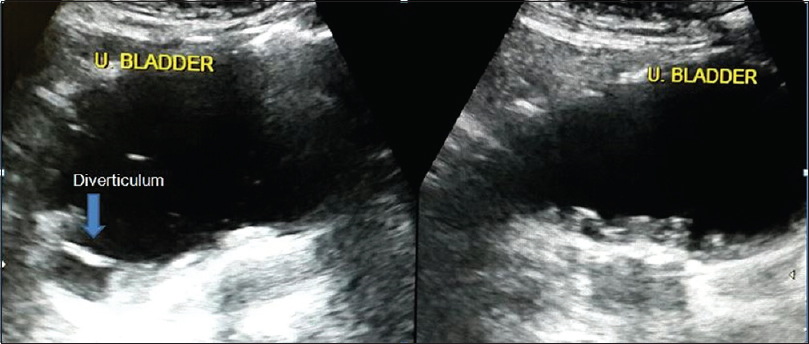 Axial and sagittal ultrasound image of the urinary bladder shows markedly thickened and trabeculated wall. Also noted is a small diverticulum along the right lateral wall communicating with lumen of the urinary bladder