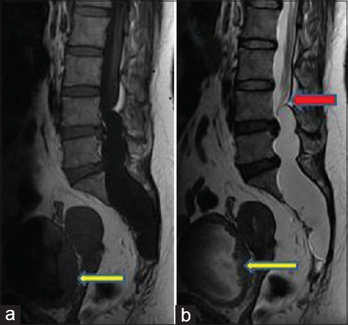 Sagittal TI-weighted imaging (a) and T2-weighted imaging (b) lobulated cerebrospinal fluid isointense lesion in the extradural space as evidenced by epidural fat capping at the superior pole of the lesion. The lesion is causing posterior scalloping of the lumbosacral vertebral bodies. Also noted is the mass effect over the cauda equina nerve roots (red arrow, image b) and thickened, trabeculated wall of urinary bladder (yellow arrows)