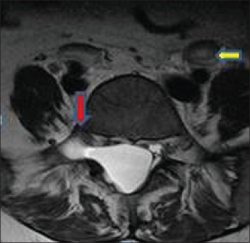 Axial T2-weighted imaging shows cerebrospinal fluid signal intensity lesion causing widening of spinal canal and right neural foramina with a displacement of the right exiting nerve root anteriory (red arrow). Also noted are bilateral dilated ureters (yellow arrow)