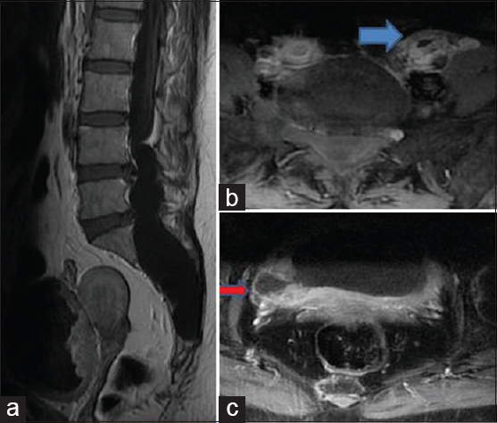 Postcontrast fat-suppressed TI-weighted imaging sagittal (a) and axial images (b and c), no evidence of any enhancement within the lesion. Mildly enhancing thickened wall of the urinary bladder and both ureters are noted (blue arrow, image b). Furthermore, noted is bladder diverticulum (red arrow, image c)