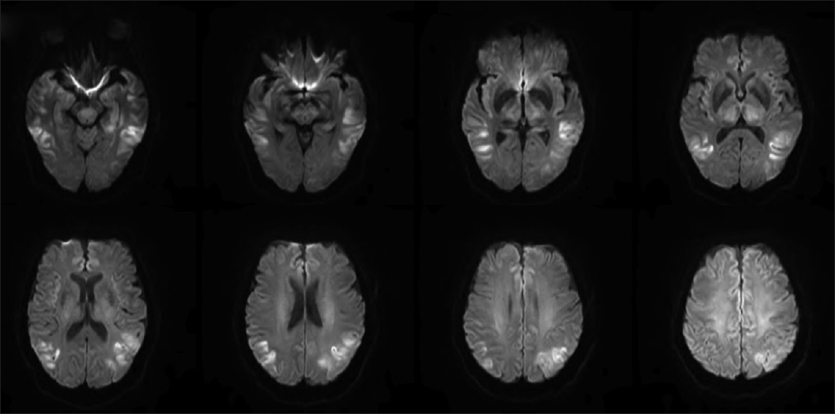 Diffusion-weighted imaging showed multiple areas of restricted diffusion involving the lateral portion of the temporal lobes extending up to the posterolateral portions of the parietal lobes along with the medial portions of the frontal lobes, thalami bilaterally, centrally within the midbrain, and also the periaqueductal gray matterthe