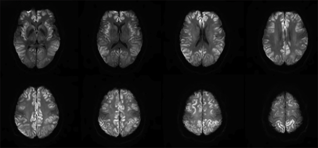 Repeat magnetic resonance imaging on day 6 showed marked progression of diffuse cortical injury involving both cerebral hemispheres and relative sparing of the perirolandic/motor-sensory cortex and cerebellum. Mild, diffuse cerebral swelling and sulcal effacement from the diffuse cortical injury without midline shift