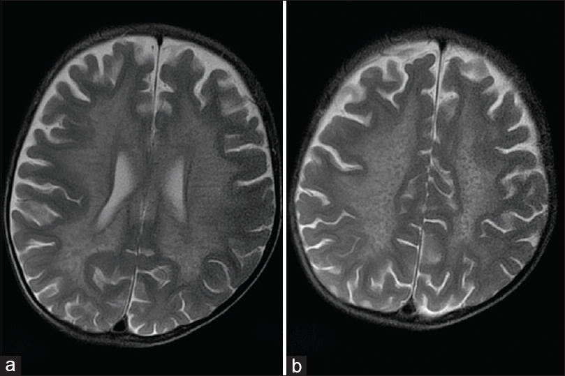 Magnetic resonance imaging axial T2-weighted images show the classical hypointense stripes and dots within the demyelinated white matter giving a “tigroid” appearance in the periventricular white matter (a) and the “leopard skin” appearance superiorly in the centrum semiovale (b)