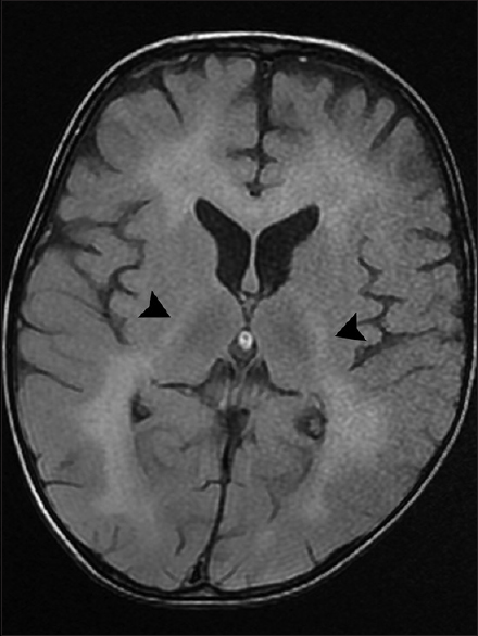 Axial T2-fluid attenuated inversion recovery image demonstrates a hyperintense signal in the posterior limb of internal capsule on both sides (arrowheads)