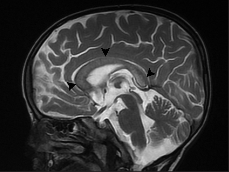 Midsagittal T2-weighted image shows the involvement of corpus callosum (arrowheads)