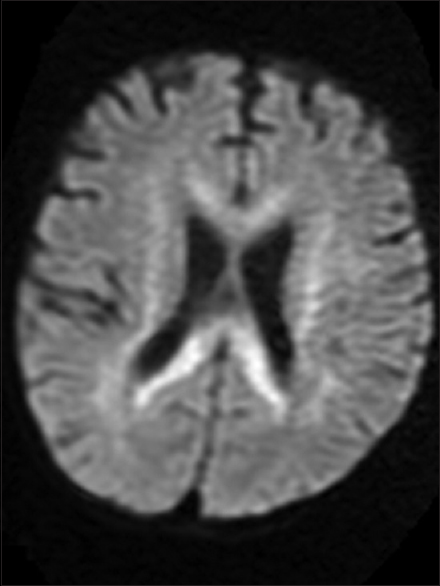 Axial diffusion-weighted image demonstrates restriction within the involved corpus callosum and periventricular white matter