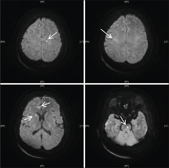 Diffusion weighted MRI bain showing infarcts in the midbrain, caudate and subcortex