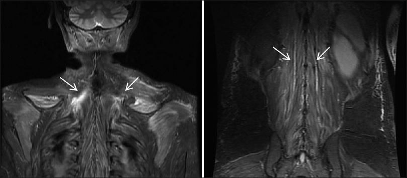 MRI showing diffuse myositis and subcutaneous oedema