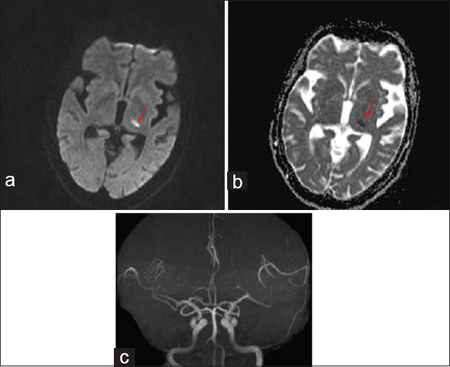 Brain magnetic resonance imaging diffusion-weighted imaging image (a) showing infarct in left lateral thalamus (red arrow); apparent diffusion coefficient image (b) showing corresponding dark signal in left lateral thalamus (red arrow); magnetic resonance angiography (c) is normal