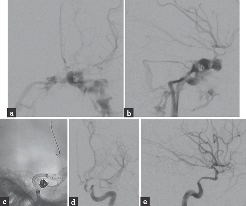 Pericardium Covered Stent Graft for Endovascular Treatment of a ...