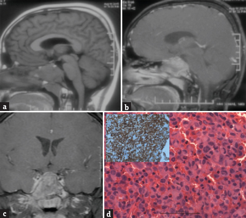 (a) Magnetic resonance imaging T1-weighted image sagittal view showing an isointense mass lesion in the sphenoid sinus, (b) the lesion is enhancing on contrast on gadolinium contrast sagittal view, and (c) coronal view. (d) Shows a microphotograph with clusters of histiocytoid cells with a convoluted, indented nucleus admixed with giant cells and mixed inflammatory cells (H and E, ×400). Inset showing the tumor cells positive for CD1a immunostain (×400) suggestive of Langerhans cell histiocytosis