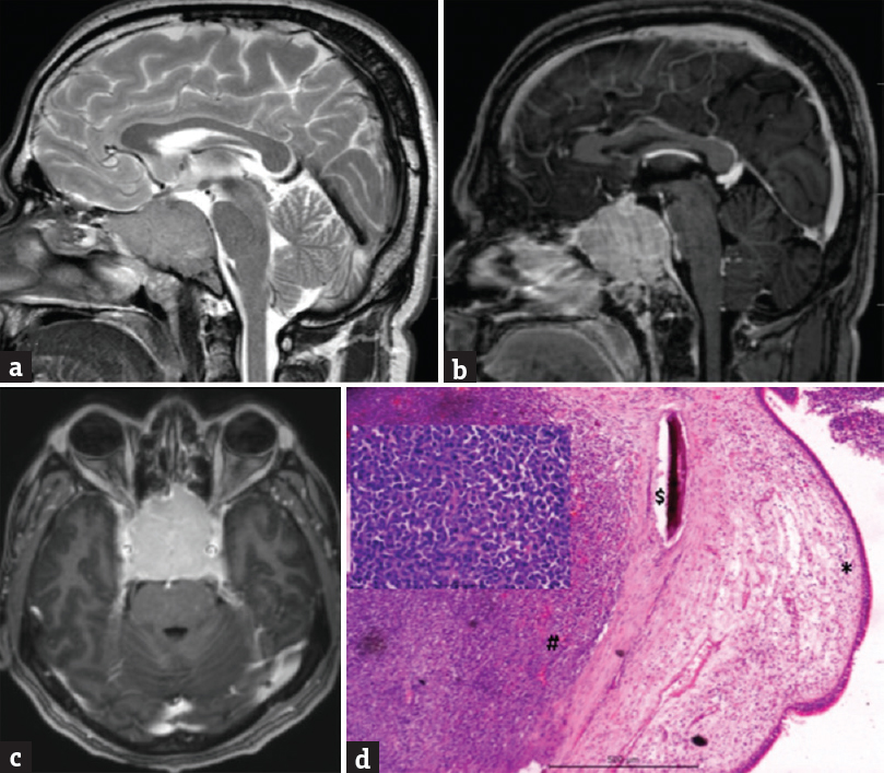 (a) Showed a T1-weighted sagittal view showing an isointense mass lesion located in the sphenoid sinus with (b) showing postgadolinium contrast enhancement of the lesion in T1-weighted sagittal images and (c) coronal images. (d) Microphotograph showing respiratory mucosa (*) with a submucosal cellular infiltrating neoplasm (#) which is infiltrating the bone ($) as well (H and E, ×100). Inset shows the tumor composed of plasmacytoid cells (H and E, ×200) suggestive of plasmacytoma