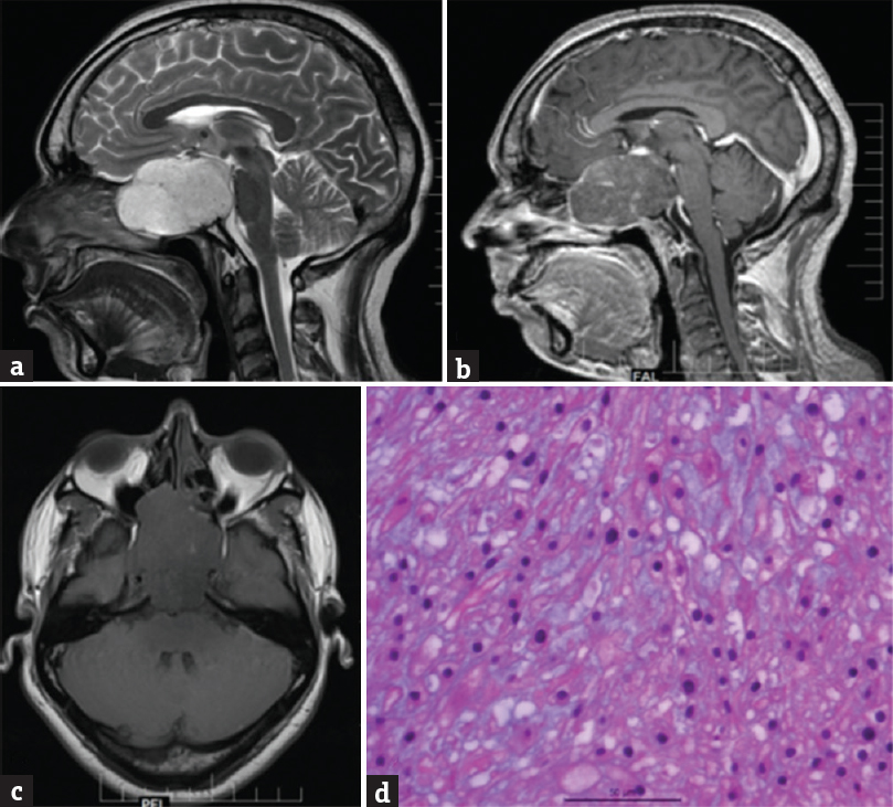 (a) Shows a T2-weighted sagittal magnetic resonance imaging with a hyperintense mass lesion located in the sphenoid sinus which is enlarged. (b) Shows the lesion in not enhancing on T1-weighted postgadolinium contrast compared to (c) axial T1-weighted image with a iso-hypointense mass located in the sphenoid sinus. (d) Microphotograph showing a myxoid neoplasm with diffusely scattered polyhedral cells having a vacuolated bubbly cytoplasm (Physaliphorous cells) in a highly myxoid stroma (H and E, ×400) suggestive of chordoma