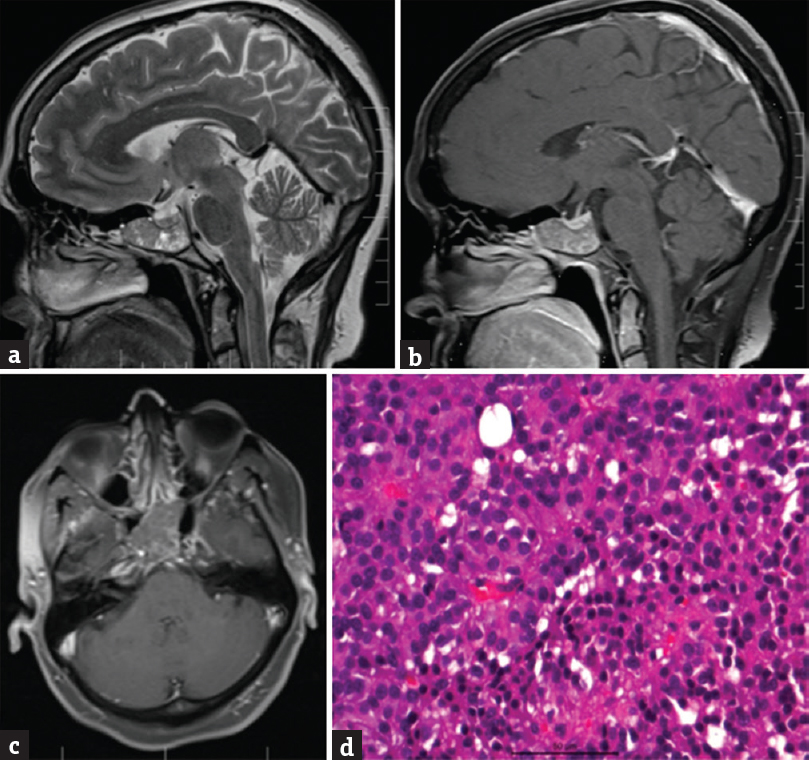 (a) Shows a T2 weighted sagittal magnetic resonance imaging image with a heterogeneously iso-hyperintense mass located in the sphenoid sinus, (b) the lesion is enhancing heterogeneously on postgadolinium contrast sagittal magnetic resonance imaging and (c) axial magnetic resonance imaging. (d) Microphotograph showing the neoplasm composed of closely packed acinar clusters of uniform round to polyhedral neuroendocrine cells (H and E, ×400) suggestive of pituitary adenoma