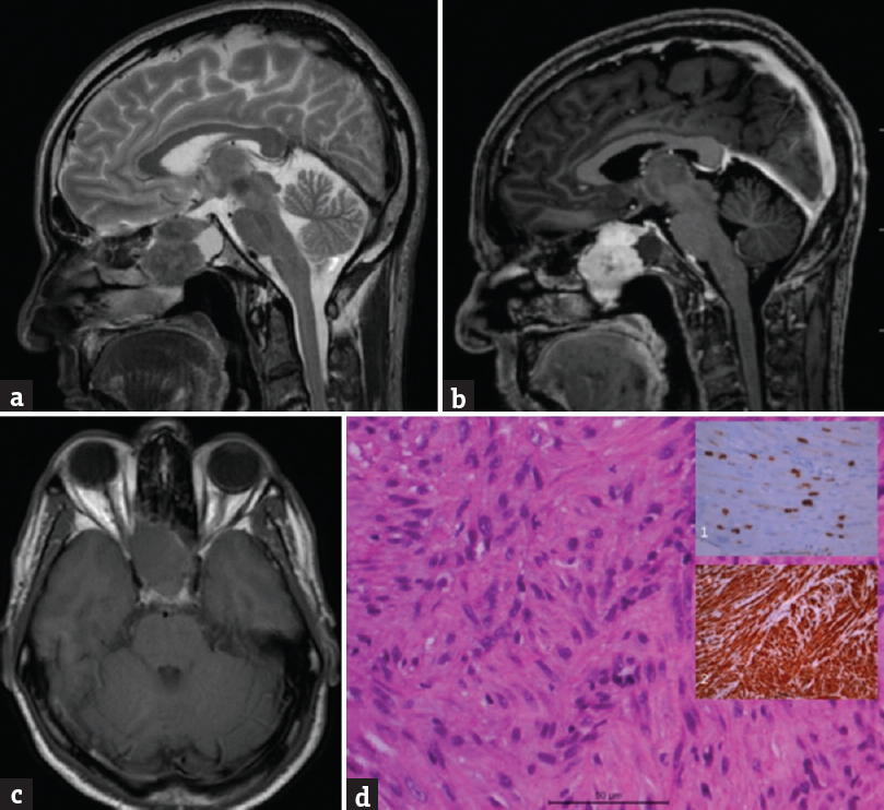 (a) Showing a T2-weighted sagittal view with a heterogeneously iso-hypointense mass lesion located in the sphenoid sinus. (b) Shows heterogonous enhancement of lesion after gadolinium administration, (c) lesion is isointense on plain T1-weighted images. (d) Microphotographs showing a cellular spindle cell tumor with interlacing fascicles; inset (1) showing the increased MIB-1 labeling and inset (2) showing positive staining for smooth muscle actin. Vimentin positive but negative for S100, desmin, creatine kinase, and CD99 suggestive of leiomyosarcoma