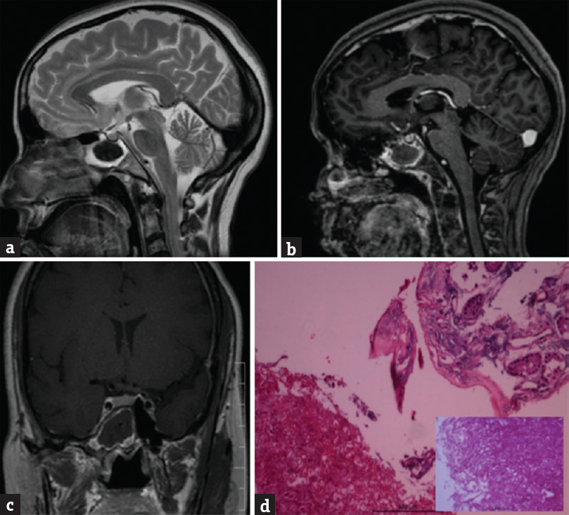 (a) Shows a T2-weighted sagittal magnetic resonance imaging with a hypointense mass lesion located inside the sphenoid sinus. (b) The lesion is not enhancing peripherally on postgadolinium T-weighted images (c) and in coronal images. (d) Microphotograph showing ulcerated mucosa with a colony of fungal hyphae morphologically resembling Aspergillus (H and E, ×100) inset shows the fungal colony with slender septate and branching hyphae (H and E, ×400)