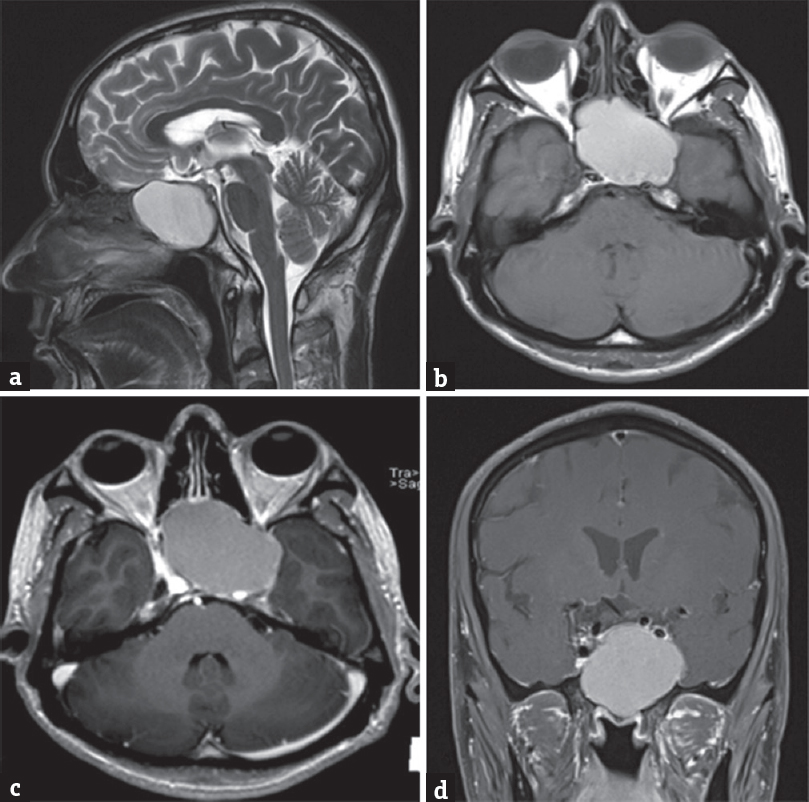 (a) Shows a T2-weighted sagittal magnetic resonance imaging with a hyperintense mass lesion in the sphenoid sinus with enlargement of sphenoid sinus. (b) The lesion is hyperintense on plain T1-weighted images and (c) not enhancing on postgadolinium injection axial and (d) coronal imagesab